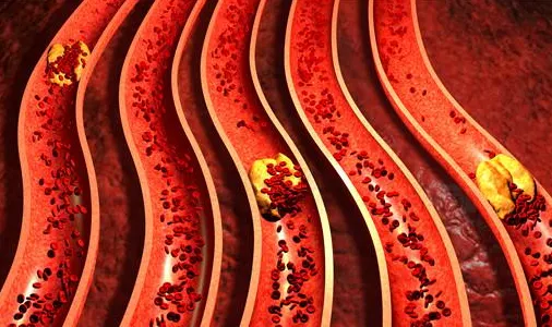 血管 “高凝” 怕血栓？2 种食材防凝结，日常吃超安心！